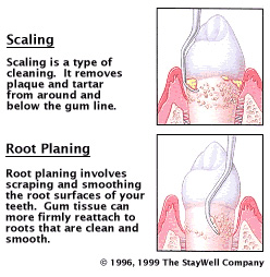 scaling root planing