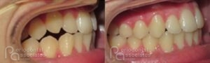 periodontal-associates_charleston_paoo_patient2c