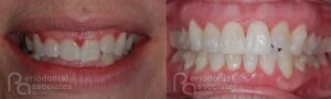 periodontal-associates_charleston_paoo_patient3b