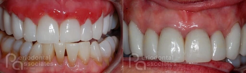 periodontal associates charleston periodontal disease patient5a