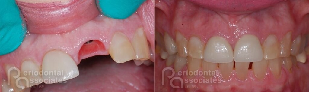 periodontal associates charleston single implant patient6a