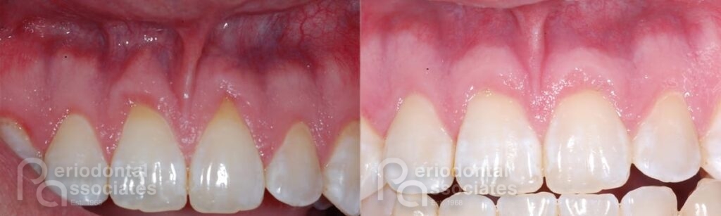 periodontal associates charleston tissue graft patient4a